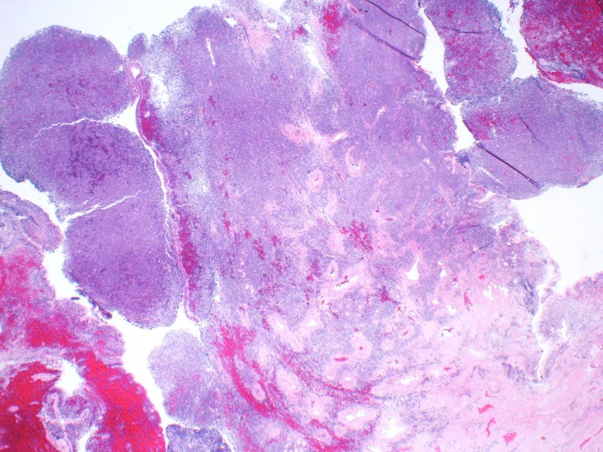 Figure 1. Ethmoid sinus biopsy with diffuse neoplastic infiltrate, 4x